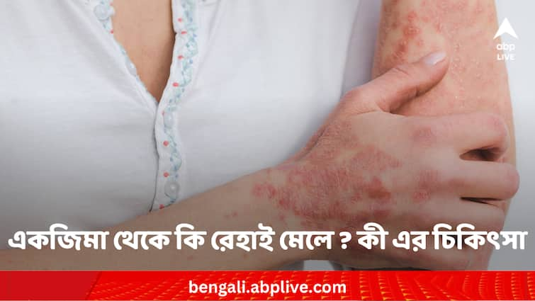 Eczema is it curable know its treatment Eczema treatment: একজিমা থেকে কি রেহাই মেলে ? কী এর চিকিৎসা