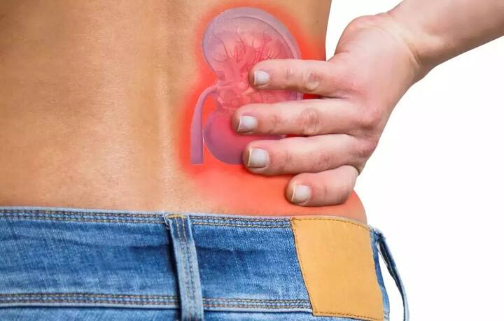 કિડની સ્ટોન- તેના વધુ પડતા ઉપયોગની આડ અસરથી  કિડનીમાં પથરી થઇ શકે . પ્રોટીન શેક જેવા ઉચ્ચ પ્રોટીન સપ્લીમેન્ટ્સ કેલ્શિયમની સાંદ્રતામાં વધારો કરે છે, જેના કારણે કિડનીમાં પથરીનું જોખમ વધી જાય છે. આજ કારણે તે તેમારા લીવરને પણ લીવરને સીધું નુકસાન કરી શકે છે.