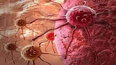 Health Tips: વારંવાર ભાગવું પડે છે વોશરૂમમાં, તો હોઈ શકે છે આંતરડાનું કેન્સર, આ રીતે ઓળખો