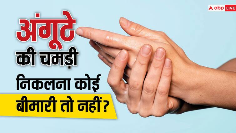 Do you also have dry skin coming off near your thumb in winter Treat it like this क्या आपके भी सर्दी में अंगूठे के पास से उतरती है ड्राई स्किन, ऐसे करें इलाज