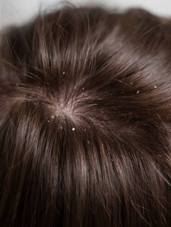 डैंड्रफ दूर करने के 5 आसान उपाय