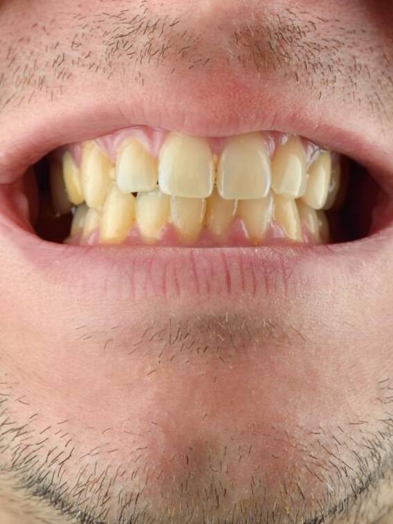 रोज ब्रश करने के बाद भी पीले क्यों हो जाते हैं दांत?