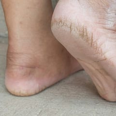 Crack Heel: ਇਹਨਾਂ ਤਰੀਕਿਆਂ ਨਾਲ ਬਣਾਓ ਫਟੀਆਂ ਅੱਡੀਆਂ ਨੂੰ ਕੋਮਲ ਤੇ ਨਰਮ