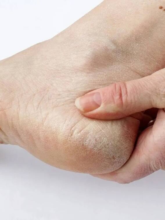 सर्दियों में फटी एड़ी से केसै राहत पाएं