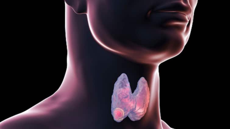 Salivary Gland Cancers Small Intestine Adenocarcinoma Anaplastic Thyroid Cancer Rare Cancers In India Strategies Prevent Salivary Gland Cancers, Small Intestine Adenocarcinoma – Rare Cancers In India And Strategies To Prevent Them