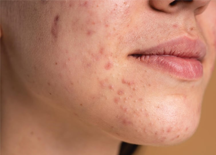 Do not ignore these symptoms appearing on the skin, they may be signs of skin cancer Health Alert: ત્વચા પર દેખાતા આ લક્ષણોને ભૂલથી પણ ન કરો ઇગ્નોર, સ્કિન કેન્સરના હોઇ શકે છે સંકેત