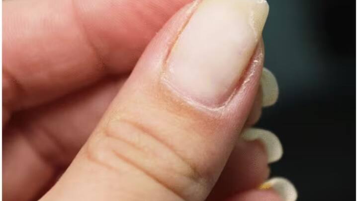 নখের ভিতরে অল্প অল্প ছোট ছোট রক্তক্ষরণ ( Splinter Hemorrhages) )হতে পারে। নখের রক্তবাহিকা ক্ষতিগ্রস্ত হলে এই রক্তক্ষরণ হতে পারে।