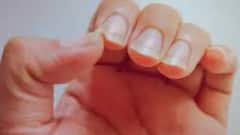 Nail Disease Symptom : ভাঙছে নখ? সাদা বা লাল ছোপ? বিকৃত আকার? চিনে নিন এই বড় অসুখের ইঙ্গিত