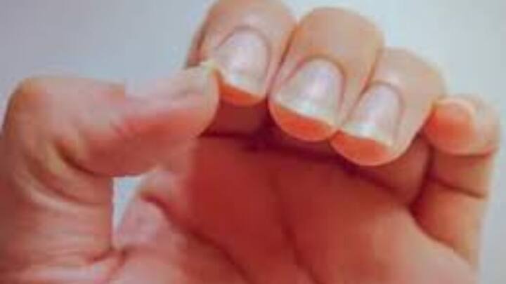 নখের নানা রকম দাগ , ব্যথা ও অন্য সমস্যায়  কমবেশি ভোগেন প্রত্যেকেই। হয়ত, নখ বলেই সেভাবে পাত্তা দেন না বেশিরভাগ মানুষ।