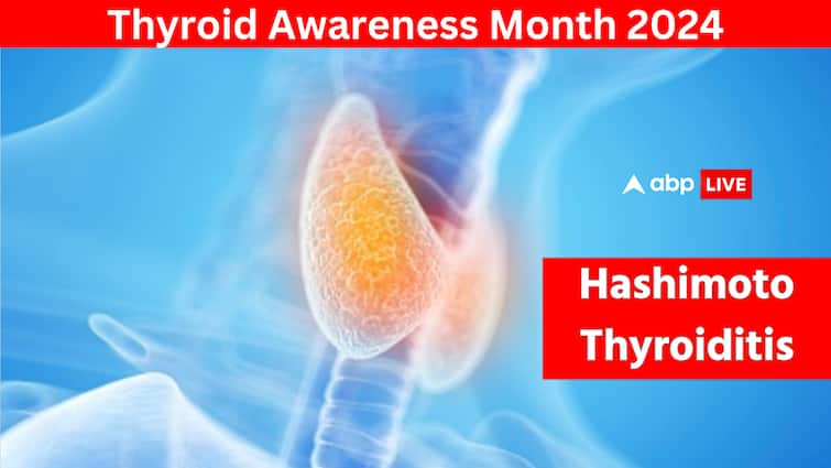 Hashimoto Thyroiditis Symptoms, Causes, Treatment Autoimmune disease ABPP What Is Hashimoto's Thyroiditis? Experts Explain Symptoms, Causes, Treatment Of This Autoimmune Disease