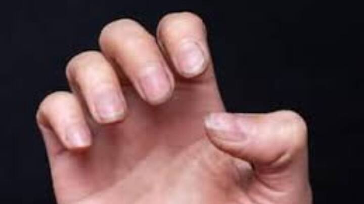 যারা দীর্ঘদিন ডায়াবেটিসে ভুগছেন তাদেরও নখের ক্ষতি হয় । নখের গোড়া চামড়া নষ্ট হয়ে যায়।  চিকিৎসকরা. নখ দেখে শরীরে অনেক কঠিন অসুখ সম্পর্কে আন্দাজ করতে পারেন