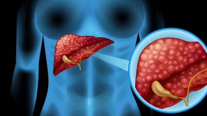 पैर में दर्द या पीठ के निचले हिस्से में दर्द इसके लक्षण हो सकते हैं और ये आमतौर पर सर्वाइकल कैंसर के बाद के लक्षणों में देखे जाते हैं.