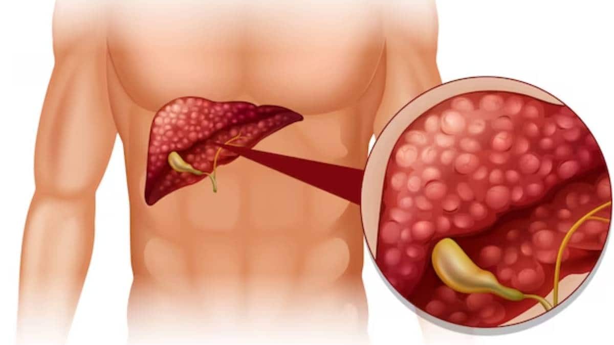 ফ্যাটি লিভার ডেকে আনে সিরোসিসও ! এই লক্ষণগুলি না চিনলেই সর্বনাশ