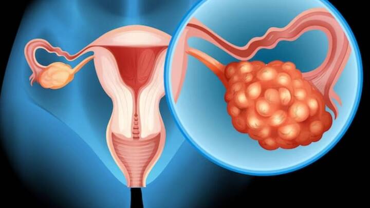 Cervical Cancer symptoms: सर्वाइकल कैंसर के शुरूआती लक्षणों को समझना बेहद जरूरी है. सर्वाइकल कैंसर के लक्षणों को समय रहते पहचानने से आप इस बीमारी को फैलने से रोक सकते हैं.