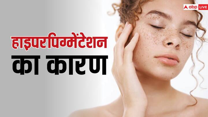 beauty tips skin hyperpigmentation causes and home remedies in hindi चेहरे की खूबसूरती पर दाग की तरह हैं झाइयां, जानें बचने के उपाय