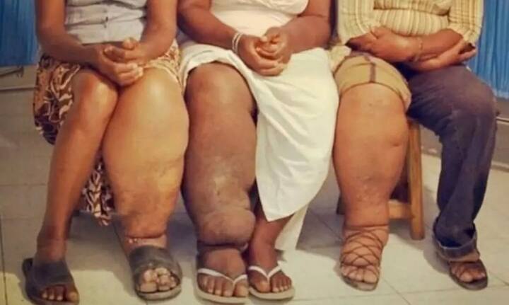 फाइलेरिया ऐसी खतरनाक बीमारी है जो मच्छर काटने शरीर को धीरे धीरे और शांत तरीके से खराब कर डालती है. डॉक्टर कहते हैं कि फाइलेरिया अक्सर कम उम्र यानी बचपन में होता है और ये बीमारी एक खास संक्रमण के चलते होती है. इस बीमारी को हाथीपांव भी कहा जाता है.