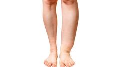 Lymphatic Filariasis: किस वजह से होता है फाइलेरिया? लक्षण दिखने में लग जाते हैं सालों...जानिए क्यों