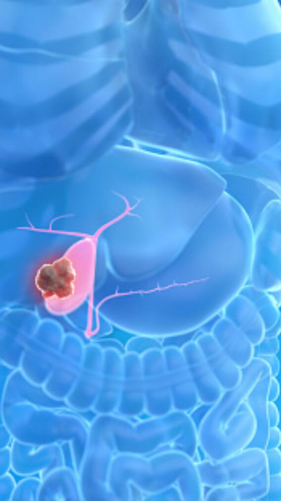 Tips To Prevent Gall Bladder Cancer