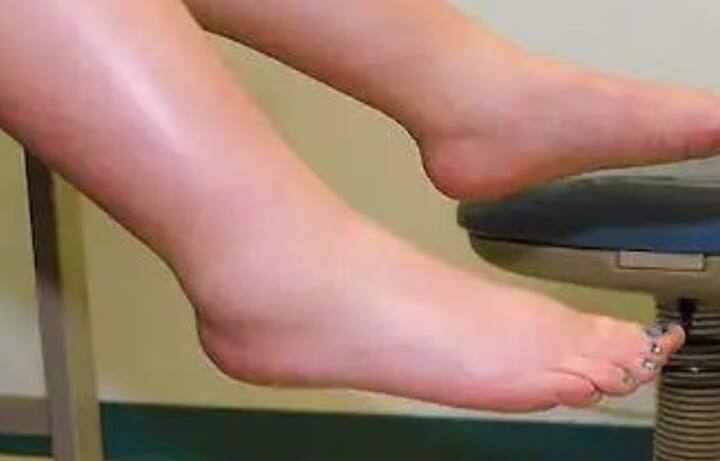 સોજો: પગની ઘૂંટીઓ જેવા શરીરના અમુક ભાગોમાં સોજો આવે તો સાવધાન થઇ જવું જરૂરી છે. આ સામાન્ય રીતે સમય સાથે વધે છે.