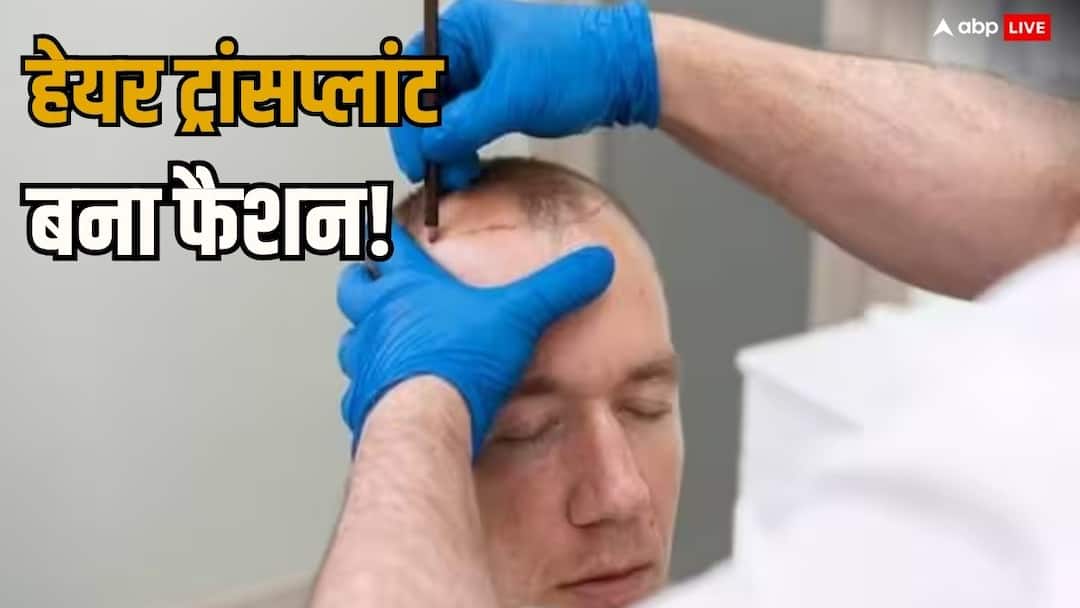 Indore around 20 people getting hair transplant every day know about FUE technique ANN Indore News: इंदौर में हर दिन करीब 20 लोग करा रहे हेयर ट्रांसप्लांट, जानें- FUE के बाद कितने दिन टिकते हैं बाल?
