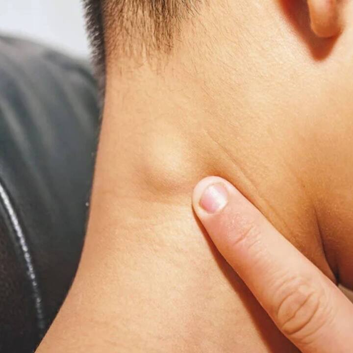 ਇਸ ਵਿੱਚ ਅਸੀਂ ਸ਼ਿਗਰੂ ਪਾਤਰਾ, ਕੰਚਨਾਰ, ਪੁਨਰਨਾਵ ਦੇ ਕਾੜੇ ਦੀ ਵਰਤੋਂ ਕਰ ਸਕਦੇ ਹਾਂ। ਕਾੜੇ ਦੀ ਵਰਤੋਂ ਕਰਨ ਲਈ ਸਾਨੂੰ ਖਾਲੀ ਪੇਟ 30 ਤੋਂ 50 ਮਿਲੀਲੀਟਰ ਕਾੜਾ ਲੈਣਾ ਚਾਹੀਦਾ ਹੈ।