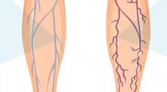 Health Tips: ਪੈਰਾਂ ਦੀਆਂ ਨੀਲੀਆਂ ਨਸਾਂ ਦਾ ਨਜ਼ਰ ਆਉਣਾ ਗੰਭੀਰ ਬਿਮਾਰੀ ਦਾ ਲੱਛਣ, ਹੋ ਸਕਦੀ ਇਹ ਬਿਮਾਰੀ