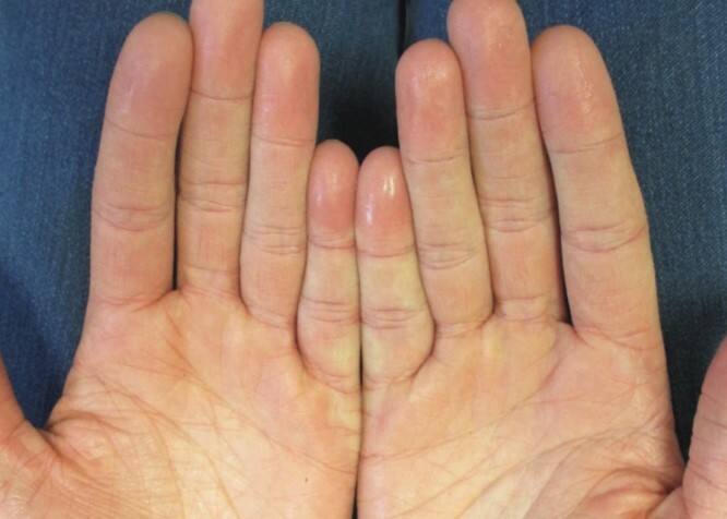 ਡਾ: ਜੈਨ ਦੱਸਦੇ ਹਨ ਕਿ ਖੁਰਾਕ ਨੂੰ ਨਿਯੰਤਰਿਤ ਕਰਕੇ ਫੈਟੀ ਲਿਵਰ ਦੀ ਬਿਮਾਰੀ ਨੂੰ ਕੰਟਰੋਲ ਕੀਤਾ ਜਾ ਸਕਦਾ ਹੈ। ਇਸ ਦੇ ਲਈ ਤੁਹਾਨੂੰ ਆਪਣੀ ਡਾਈਟ 'ਚ ਨਮਕ ਅਤੇ ਆਟਾ ਘੱਟ ਕਰਨਾ ਹੋਵੇਗਾ। ਇਸ ਤੋਂ ਇਲਾਵਾ ਰੋਜ਼ਾਨਾ ਕਸਰਤ ਕਰਨਾ ਜ਼ਰੂਰੀ ਹੈ। ਫਾਸਟ ਫੂਡ ਤੋਂ ਦੂਰ ਰਹੋ ਅਤੇ ਜੇਕਰ ਤੁਹਾਨੂੰ ਬਦਹਜ਼ਮੀ, ਪੇਟ 'ਚ ਜ਼ਿਆਦਾ ਗੈਸ ਬਣਨਾ ਵਰਗੀਆਂ ਸਮੱਸਿਆਵਾਂ ਦਾ ਸਾਹਮਣਾ ਕਰਨਾ ਪੈ ਰਿਹਾ ਹੈ ਤਾਂ ਤੁਰੰਤ ਡਾਕਟਰ ਨਾਲ ਸੰਪਰਕ ਕਰੋ।