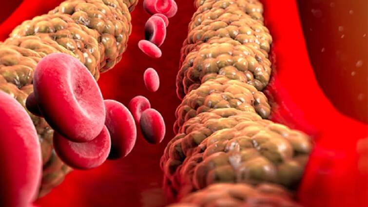 Be careful about these signs of high cholesterol that will be seen in the legs signs and warning Cholesterol: எச்சரிக்கை மக்களே.. அதிக கொழுப்பு.. உங்கள் கால்களில் இந்த அறிகுறிகள் உள்ளதா?