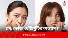 Skin Picking Disorder: ব্রণ, ফোঁড়া হলেই খোঁটাখুঁটির অভ্যাস ? কীসের লক্ষণ ?