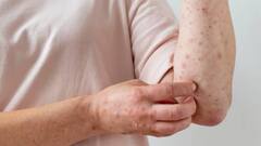 मध्‍यप्रदेश में खसरे से दो बच्चों की मौत 17 संक्रमित, तेजी से बच्चों की बीच फैल रही है ये बीमारी...जानें इसके लक्षण