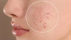 बार-बार फुंसियों से भर जाता है मुंह, तो ट्राई करें ये फेस मास्क्स