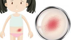 Health Tips: तेजी से बच्चों की बीच फैल रही है ये बीमारी...जानें इसके लक्षण