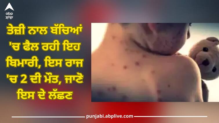 2 children die of suspected measles 17 infected in madhya pradesh maihar health news Kids Health: ਤੇਜ਼ੀ ਨਾਲ ਬੱਚਿਆਂ 'ਚ ਫੈਲ ਰਹੀ ਇਹ ਬਿਮਾਰੀ, ਇਸ ਰਾਜ 'ਚ 2 ਦੀ ਮੌਤ, ਜਾਣੋ ਇਸ ਦੇ ਲੱਛਣ