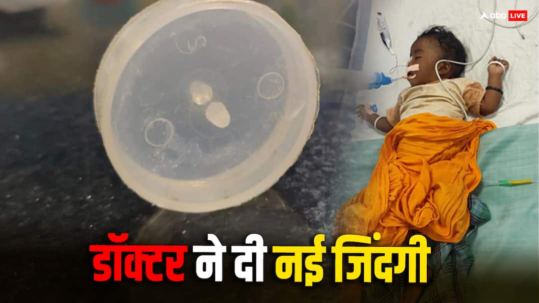 Chhattisgarh: बस्तर में डॉक्टरों ने बचाई मासूम की जान, 7 महीने के बच्चे के गले से निकाला प्लास्टिक का ढक्कन Plastic lid stuck in 7 month old child neck removed after surgery in Bastar Chhattisgarh ann Chhattisgarh: बस्तर में डॉक्टरों ने बचाई मासूम की जान, 7 महीने के बच्चे के गले से निकाला प्लास्टिक का ढक्कन