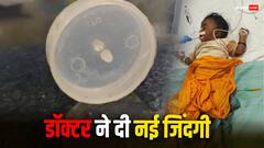 छत्तीसगढ़: बस्तर में डॉक्टरों ने बचाई मासूम की जान, 7 महीने के बच्चे के गले से निकाला प्लास्टिक का ढक्कन