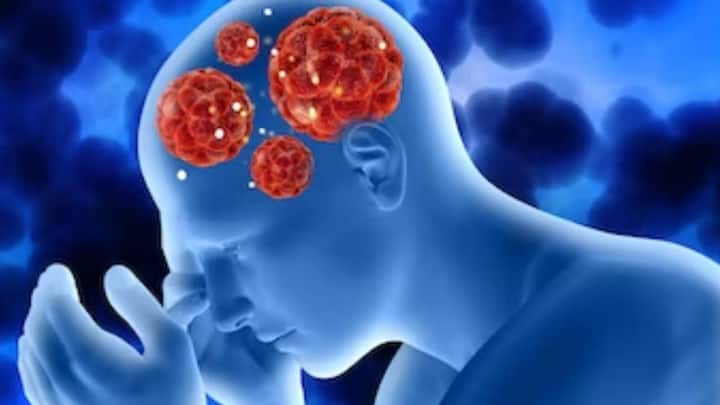 ब्रेन हेमरेज जानलेवा और गंभीर स्थिति है जिसमें व्यक्ति की जान भी जा सकती है. ज्यादातर लोग ब्रेन हेमरेज के बारे में जानते हैं लेकिन उन्हें इस बात की जानकारी नहीं है कि इस दौरान शरीर में किस तरह के बदलाव होते हैं. ब्रेन हेमरेज में ब्रेन के अंदर ब्लीडिंग होने लगता है. यानि सिर के अंदर नस फटने के कारण खून बहना. मेडिकल टर्म में इसे इंट्राक्रैनियल हेमोरेज (intracranial hemorrhage) के नाम से जाना जाता है. ब्रेन हमेरेज को लेकर सबसे बड़ा सवाल यह उठता है कि आखिर यह कैसे होता है? और इससे कैसे बचा जा सकता है.