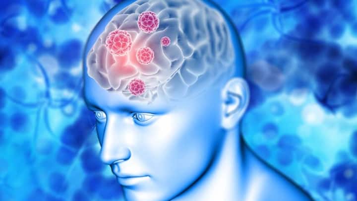 ब्रेन हमरेज के कई कारण हो सकते हैं. जैसे किसी व्यक्ति को सिर में गंभीर चोट लग गई हो. गंभीर चोट, कार दुर्घटना, सिर पर किसी तरह के चोट लगने से ब्रेन हेमरेज हो सकता है.