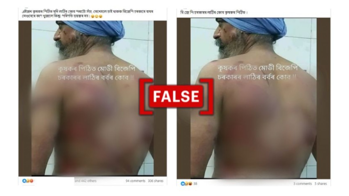 Fact Check: Image Of Man In Turban With Bruises On His Back Not Linked To Farmer Protest