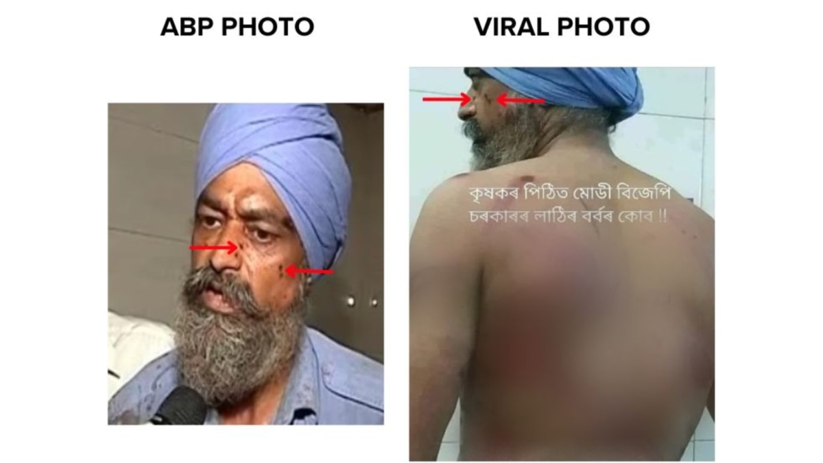 Fact Check: Image Of Man In Turban With Bruises On His Back Not Linked To Farmer Protest