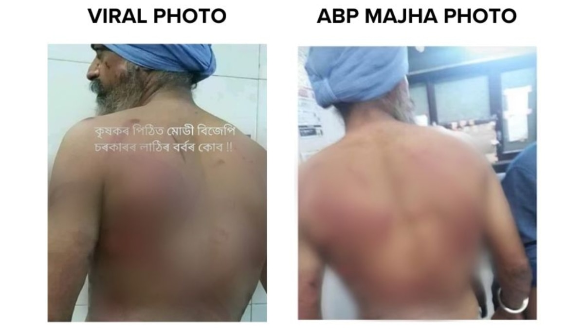 Fact Check: Image Of Man In Turban With Bruises On His Back Not Linked To Farmer Protest