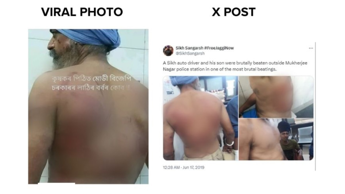 Fact Check: Image Of Man In Turban With Bruises On His Back Not Linked To Farmer Protest