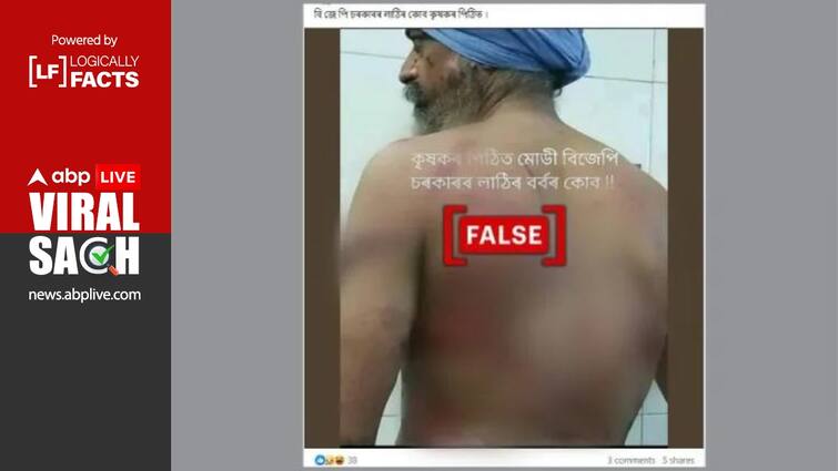 photo of turbaned Man with injuries falsely Linked To Farmer Protest Fact Check: Image Of Man In Turban With Bruises On His Back Not Linked To Farmer Protest