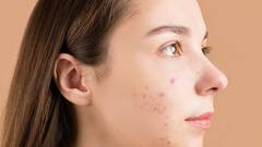 Acne Remedy : முகப்பருக்கள் சட்டுன்னு மறையனுமா? வெங்காயத்தை முகத்தில் இப்படி தடவுங்கள்!