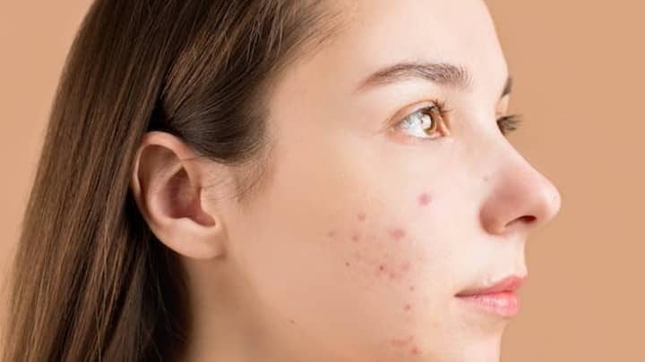 Acne Remedy : உங்கள் முகத்தில் உள்ள பருக்கள் நீங்க வேண்டும் என்றால் வெங்காயத்தை இந்த முறையில் பயன்படுத்துங்கள்.