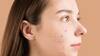 Acne Remedy : முகப்பருக்கள் சட்டுன்னு மறையனுமா? வெங்காயத்தை முகத்தில் இப்படி தடவுங்கள்!