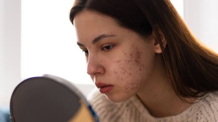 यह त्वचा को साफ और मुलायम बनाए रखता है. कच्चे प्याज में क्वर्सेटिन नामक एंटीऑक्सीडेंट पाया जाता है जो स्किन को सॉफ्ट और ग्लोइंग बनाता है. यह मुहांसों, दाग-धब्बों और सूजन को कम करने में मददगार है.