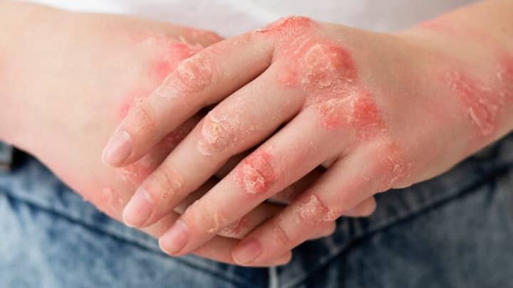 डर्मेटोमायोसाइटिस एक दुर्लभ प्रकार की ऑटोइम्यून बीमारी है, जो मांसपेशियों में सूजन और कमजोरी के साथ-साथ त्वचा पर चकत्ते उत्पन्न करती है. यह बीमारी मांसपेशियों और त्वचा दोनों को प्रभावित करती है, जिससे शारीरिक कमजोरी और थकान महसूस होती है.