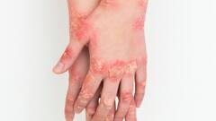 डर्मेटोमायोसाइटिस खतरनाक बीमारी जानें किस उम्र के लोगों को ज्यादा होती है