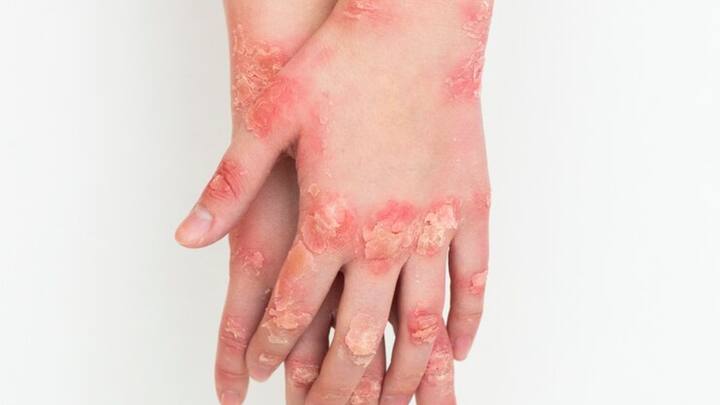 डर्मेटोमायोसाइटिस दो मुख्य उम्र समूहों में अधिक देखा जाता है - पहला, बच्चों में, जिनकी उम्र 5 से 15 वर्ष के बीच होती है, और दूसरा, वयस्कों में, जिनकी उम्र 40 से 60 वर्ष के बीच होती है. यह बीमारी महिलाओं में पुरुषों की तुलना में अधिक आम है.