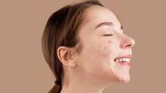 Acne Remedy : முகப்பருக்கள் சட்டுன்னு மறையனுமா? வெங்காயத்தை முகத்தில் இப்படி தடவுங்கள்!